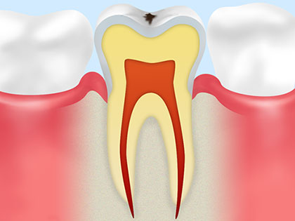C0：ごく初期段階の虫歯