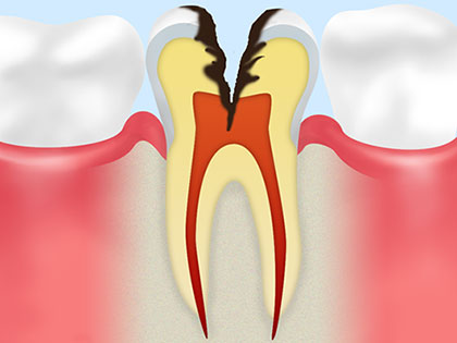 C3：歯の神経の虫歯