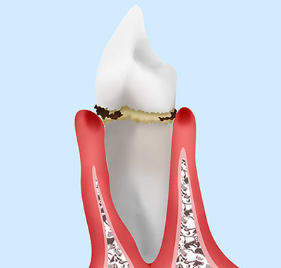 歯肉炎と軽度歯周炎